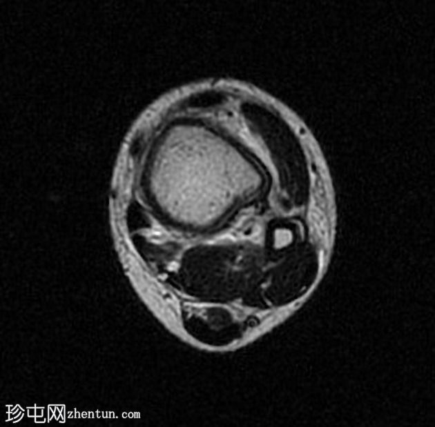 病理性骨折-非骨化纤维瘤