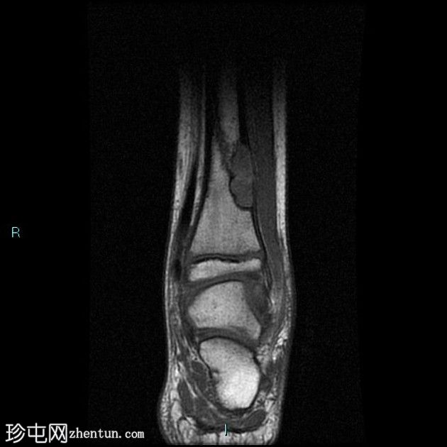 病理性骨折-非骨化纤维瘤