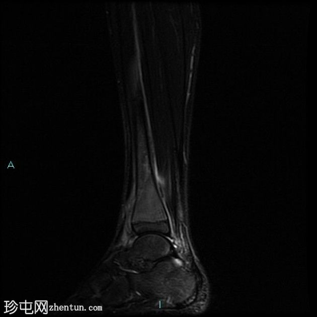 病理性骨折-非骨化纤维瘤