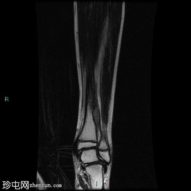 病理性骨折-非骨化纤维瘤