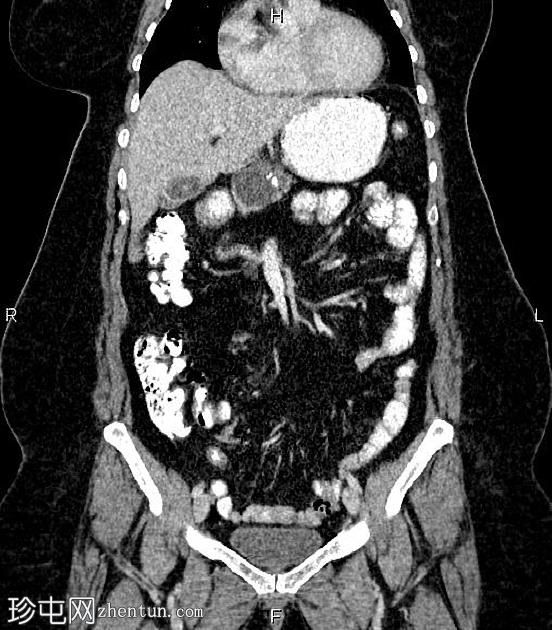 胰腺浆液性囊腺瘤