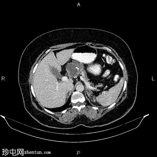 胰腺浆液性囊腺瘤