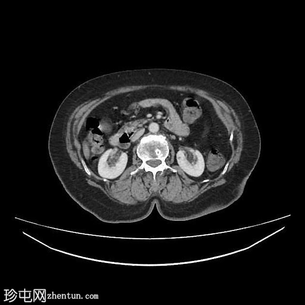 肠憩室梗阻性黄疸综合征（Lemmel Syndrome）