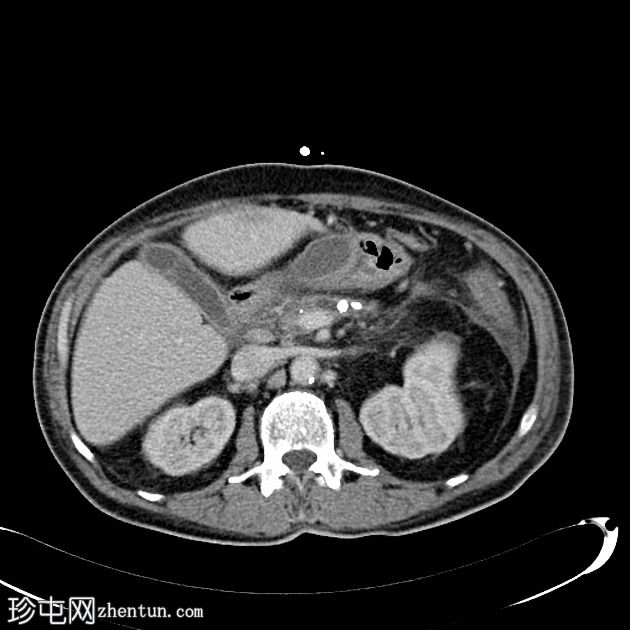 慢性胰腺炎合并肝内和脾内假性囊肿