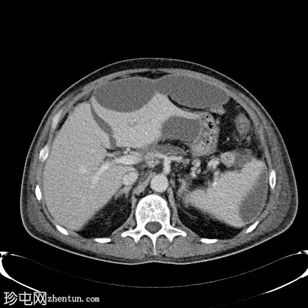 慢性胰腺炎合并肝内和脾内假性囊肿