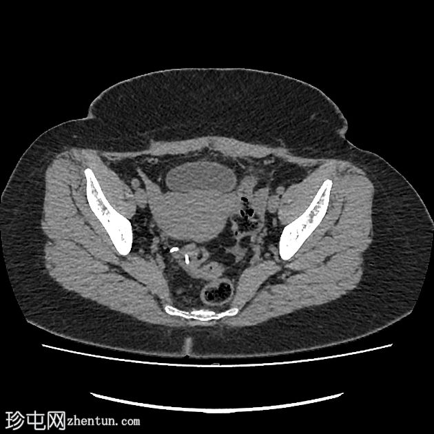 IUCD的腹膜迁移