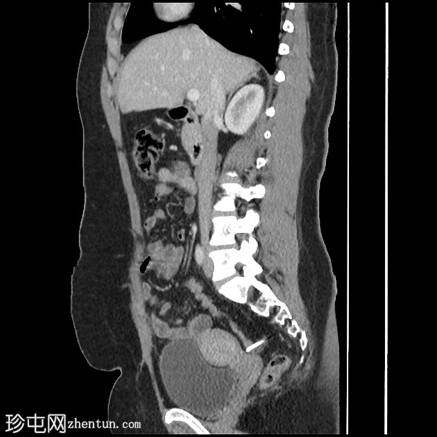 IUCD的腹膜迁移