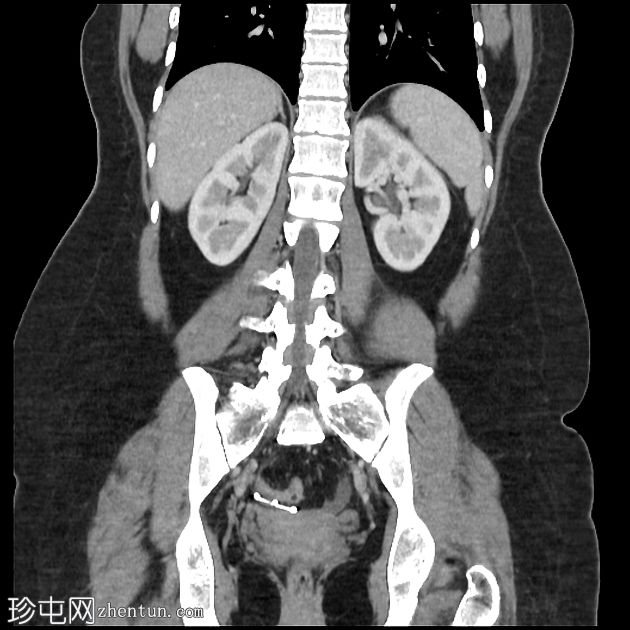 IUCD的腹膜迁移