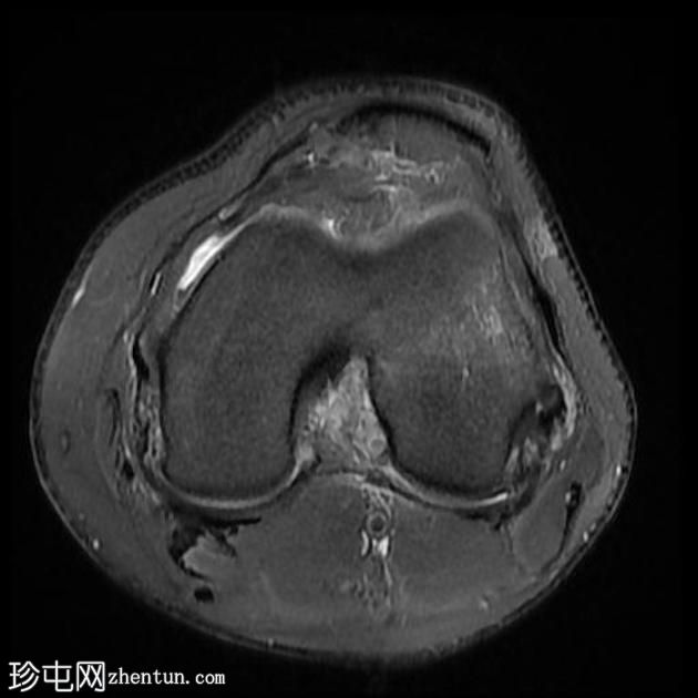 前交叉韧带撕裂-完全