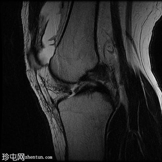 前交叉韧带撕裂-完全