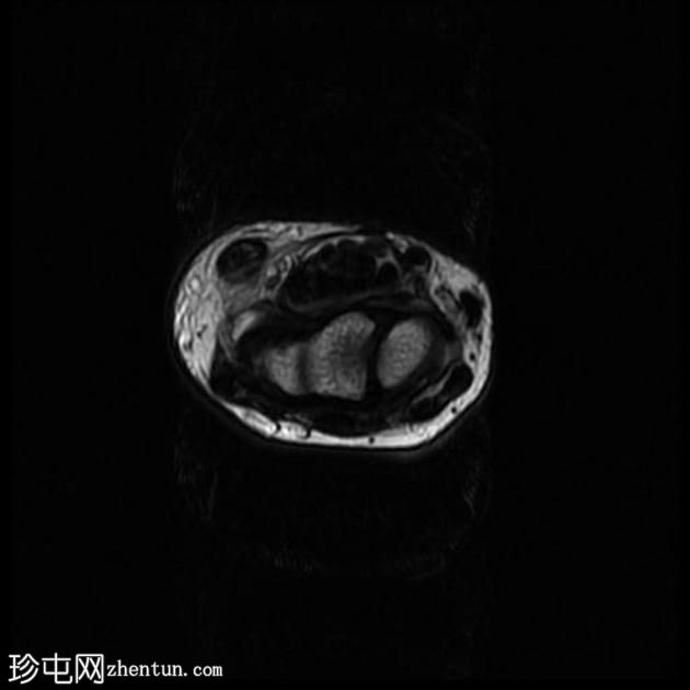 尺侧腕屈肌部分撕裂，鱼际肌群拉伤