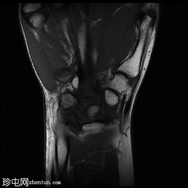 尺侧腕屈肌部分撕裂，鱼际肌群拉伤