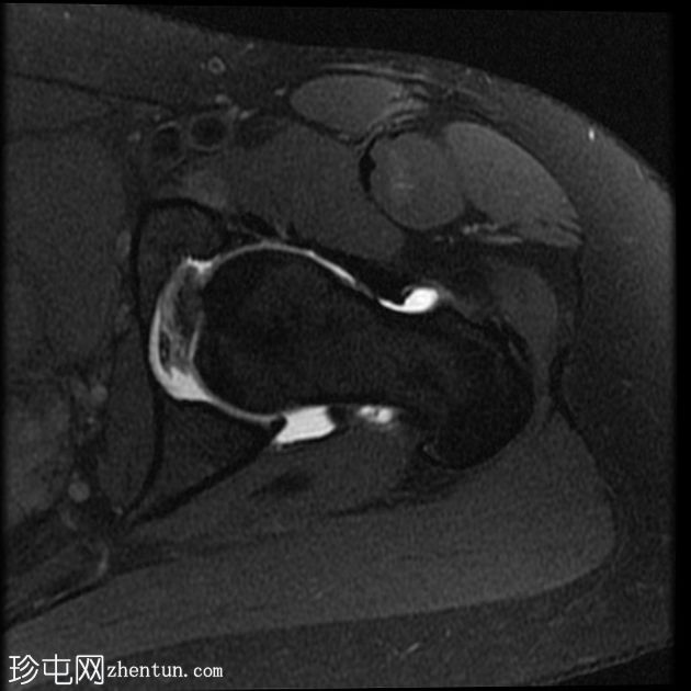 髋关节旁囊肿(超声和MRI)