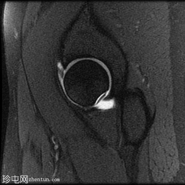 髋关节旁囊肿(超声和MRI)