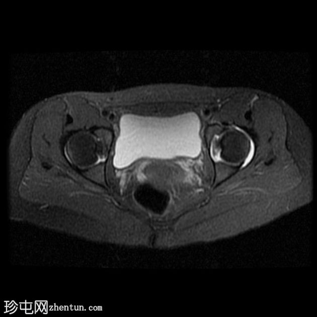 髋关节旁囊肿(超声和MRI)