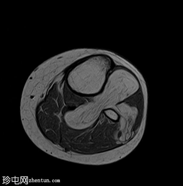 骨旁脂肪瘤压迫腓骨总神经