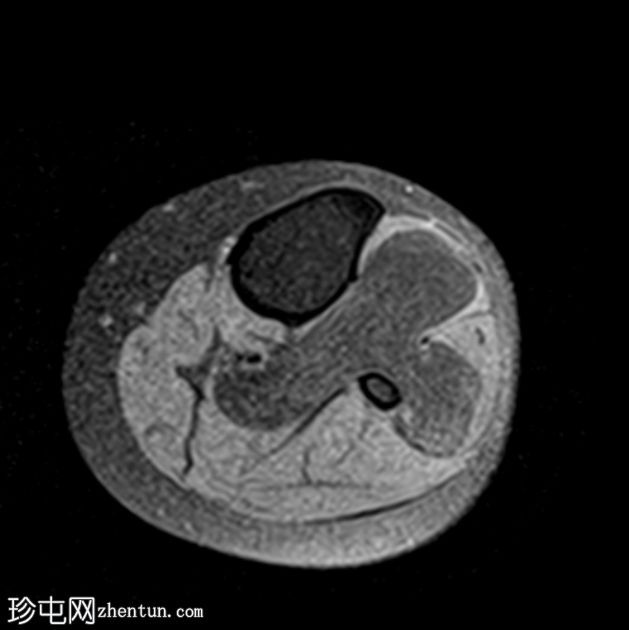 骨旁脂肪瘤压迫腓骨总神经