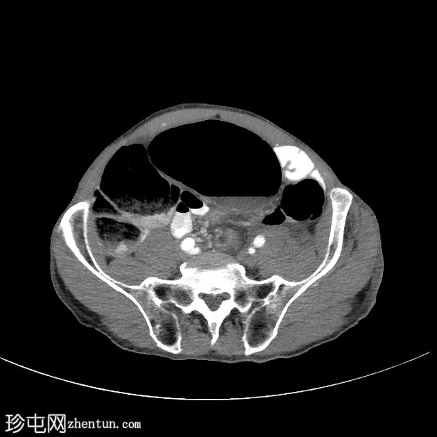 乙状结肠扭转伴旋转征