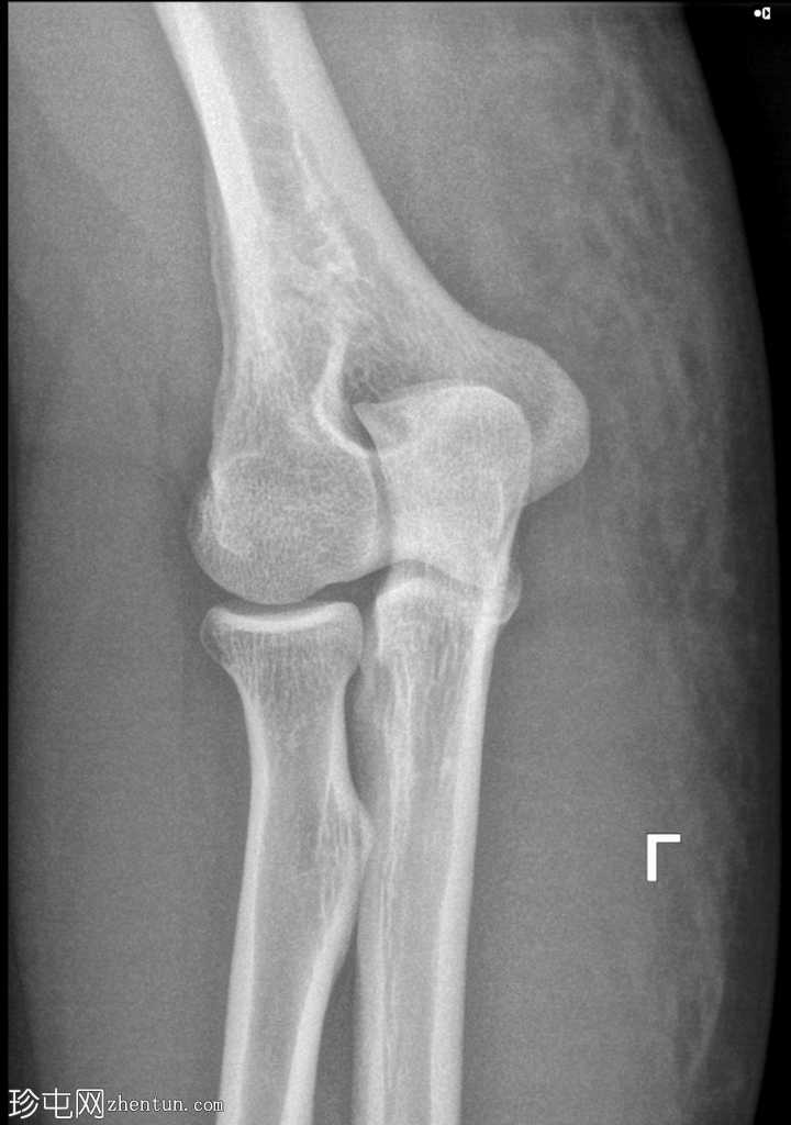 冠状突骨折-肘部