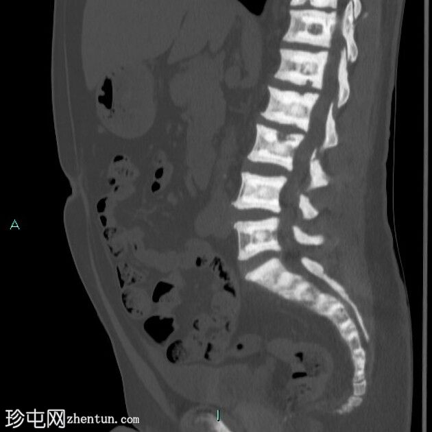 骨质疏松症