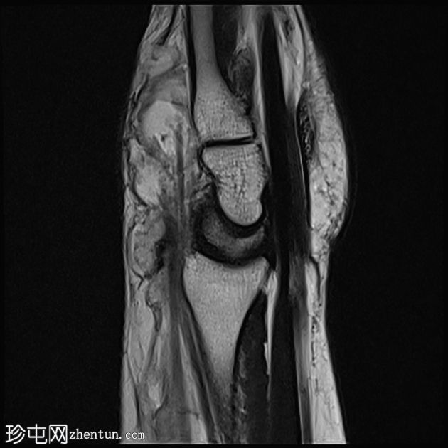 腕部第四伸肌腱鞘炎