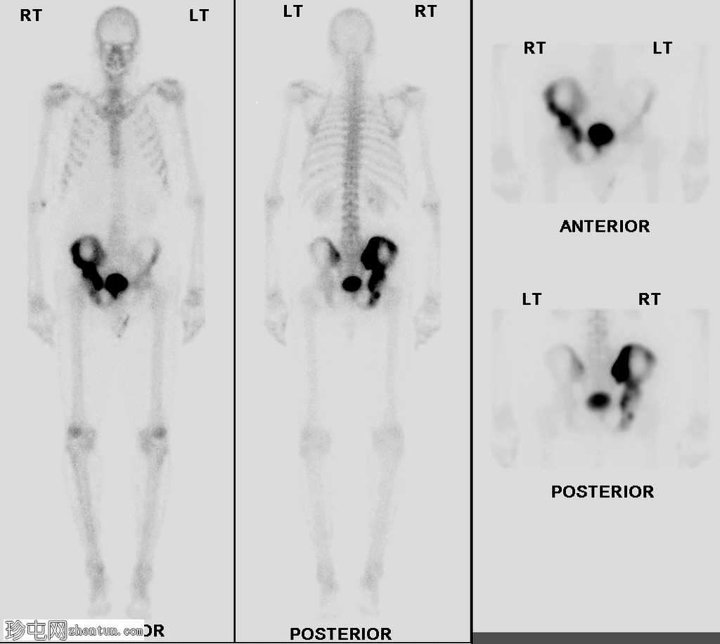 佩吉特氏病（骨闪烁扫描）