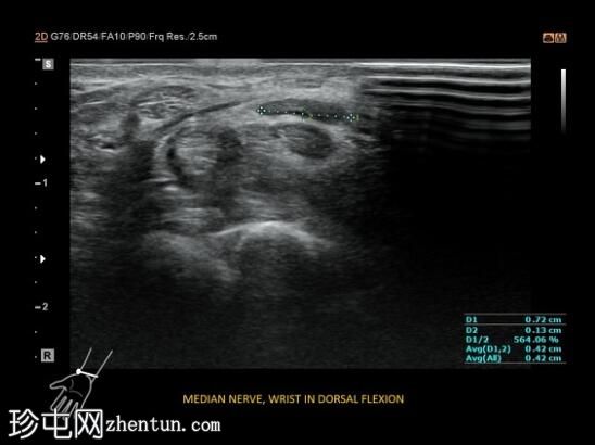 复发性腕管综合征