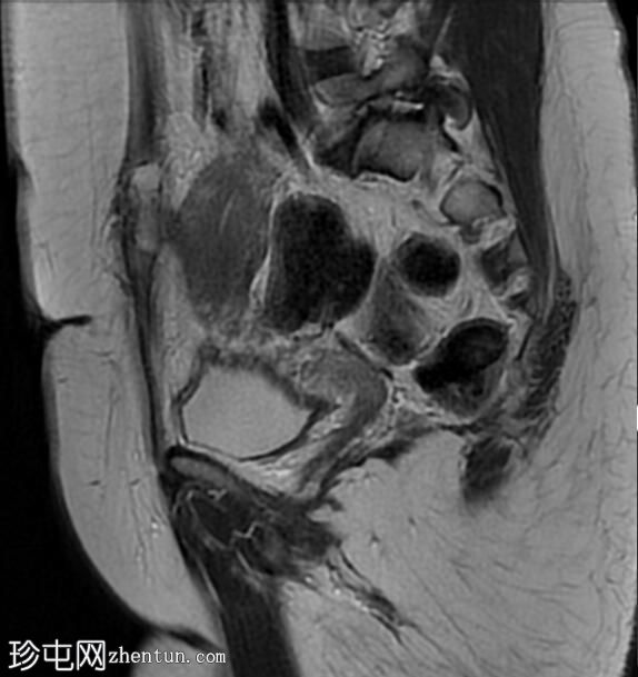 疤痕子宫内膜异位症——腹直肌