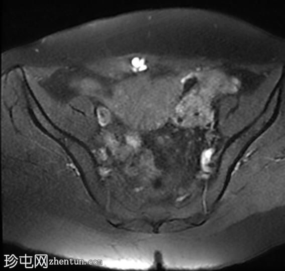 疤痕子宫内膜异位症——腹直肌