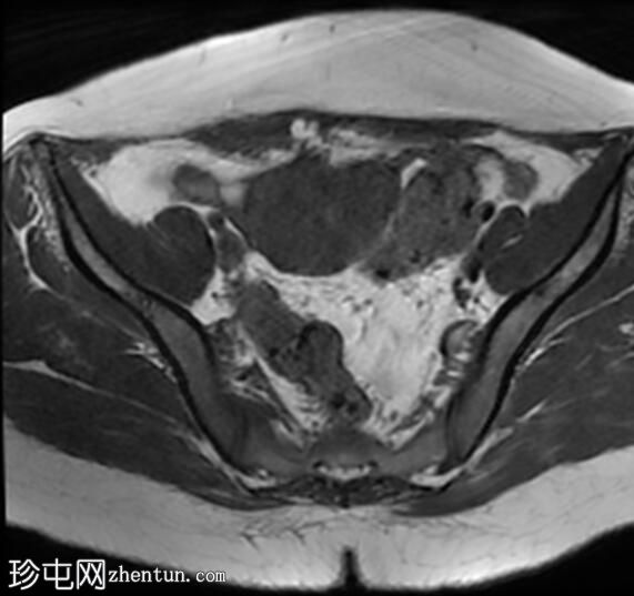 疤痕子宫内膜异位症——腹直肌