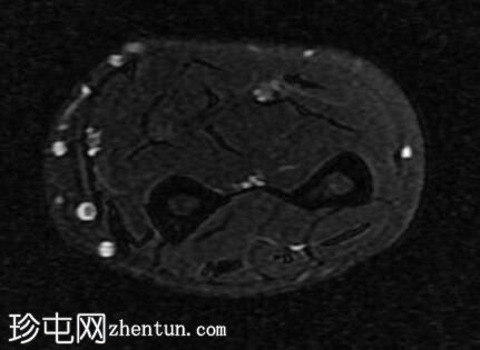 尺侧腕屈肌腱变性