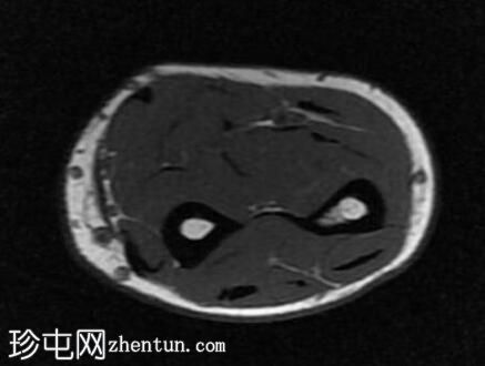 尺侧腕屈肌腱变性