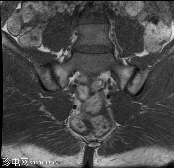 骶髂关节炎 - 单侧