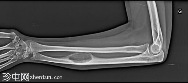 骨膜下动脉瘤性骨囊肿 (ABC) - 尺骨