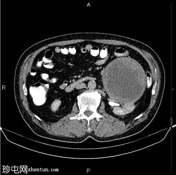 肾细胞癌伴显性坏死改变