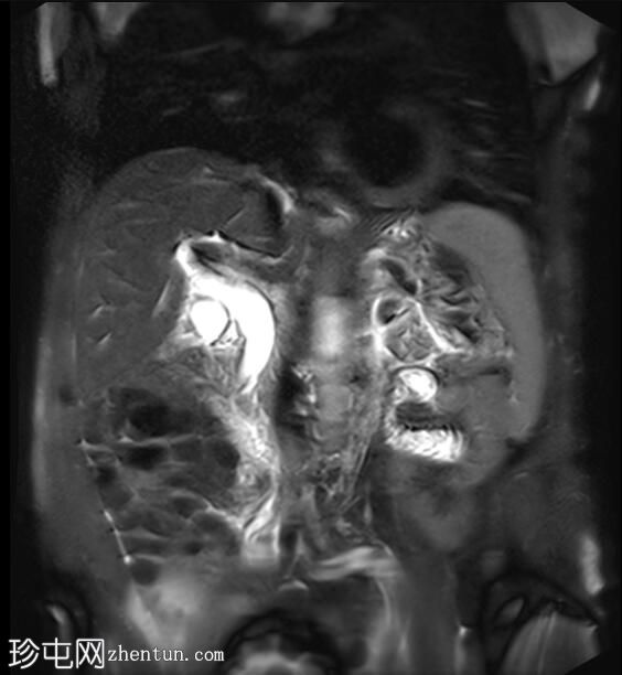 急性胰腺炎（MRCP）