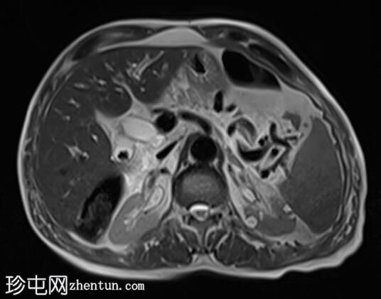 急性胰腺炎（MRCP）