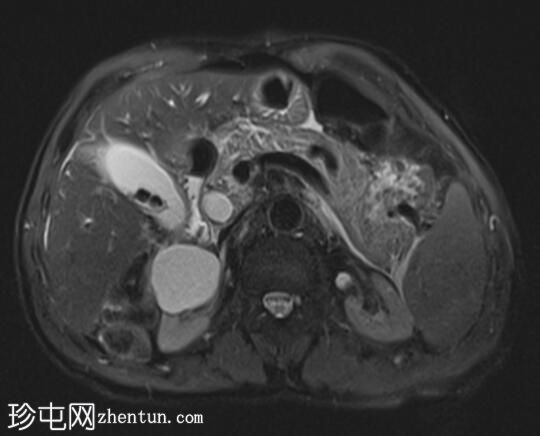 急性胰腺炎（MRCP）