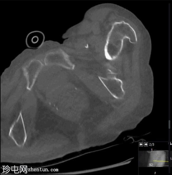 隐匿性髋部骨折