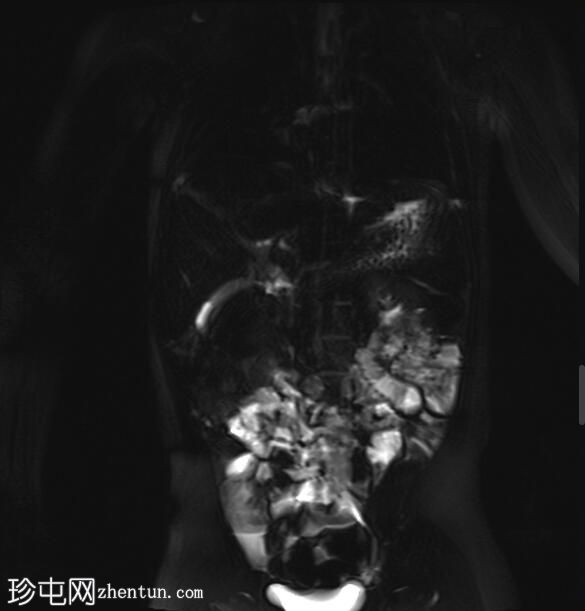 胆总管囊肿 - 1 型