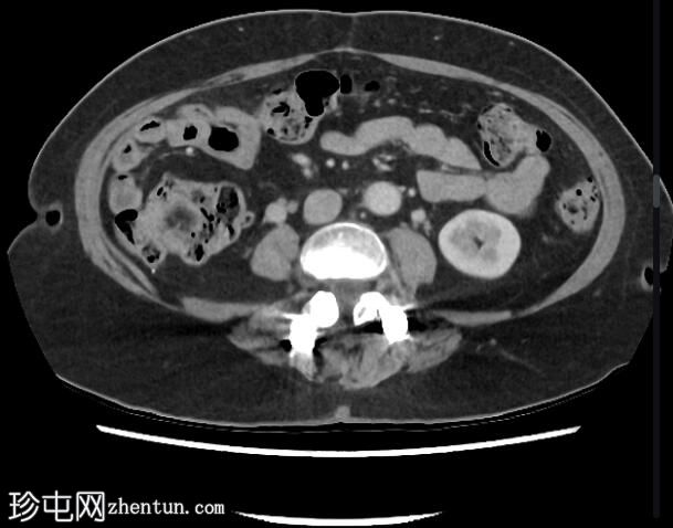 回肠套叠 - 脂肪瘤引导点