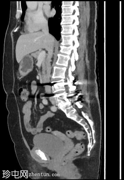 回肠套叠 - 脂肪瘤引导点
