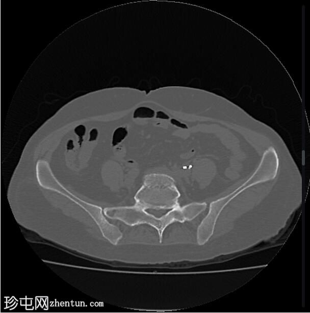 移位双J支架