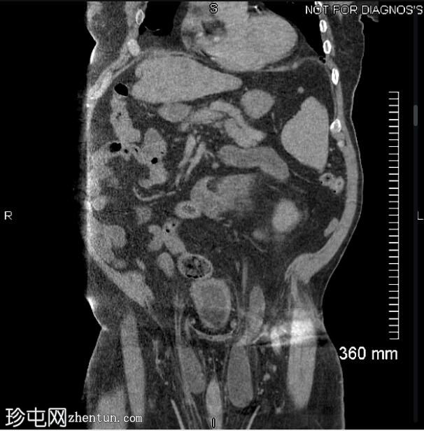 双侧输尿管腹股沟疝引起的肾积水