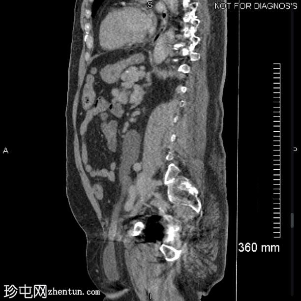 双侧输尿管腹股沟疝引起的肾积水