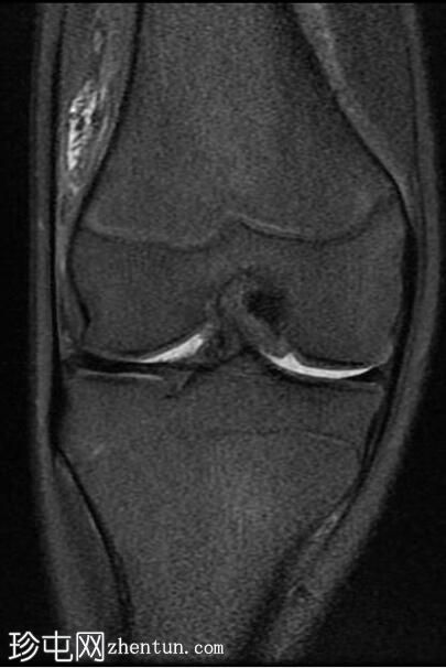 膝关节弥漫性腱鞘巨细胞瘤