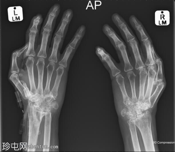 类风湿性关节炎——手和膝盖