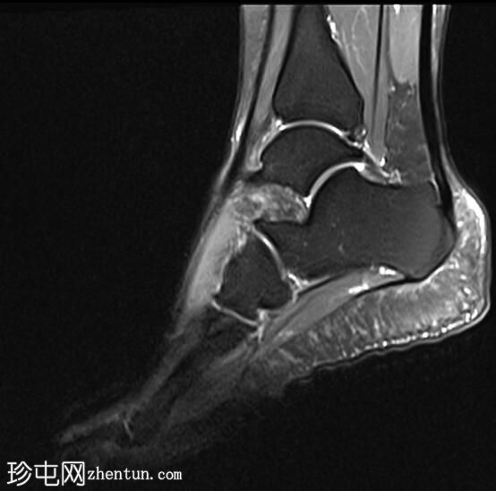 足底内侧神经纤维脂肪瘤性错构瘤