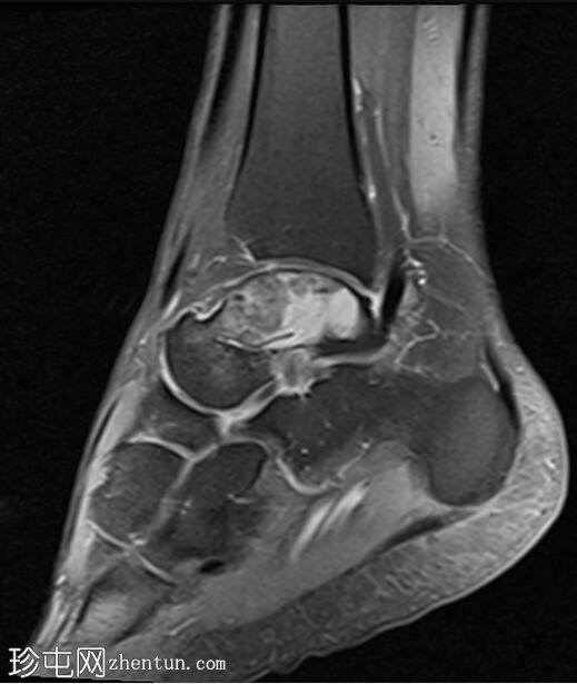 踝关节软骨粘液样纤维瘤