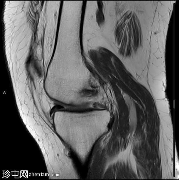 膝关节软骨下功能不全骨折和复杂的半月板撕裂